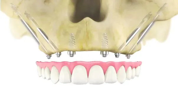 Zygomatic Dental Implants: A Breakthrough in Dental Restoration